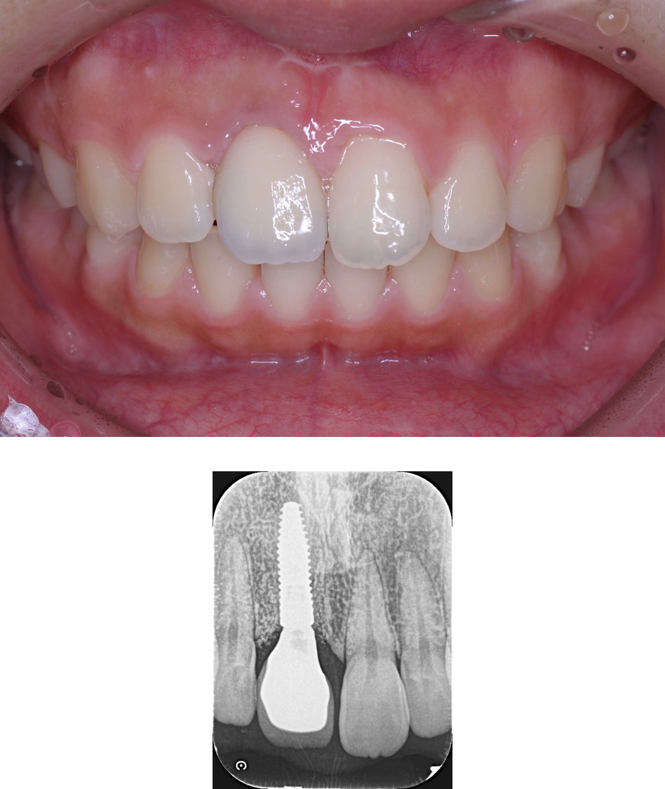 ②インプラント審美障害（after