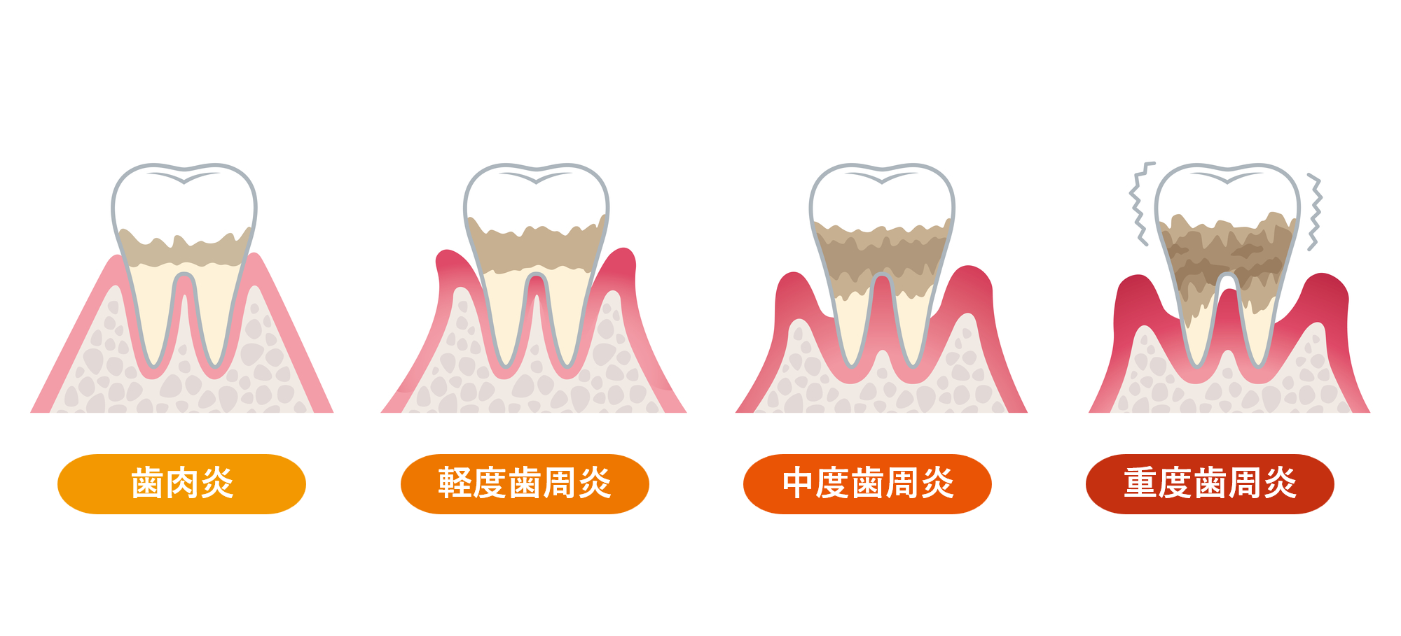 歯周病の進行度