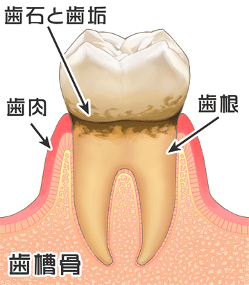 口や歯がザラザラする・気になる原因