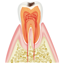 エナメル質に影響し始めた虫歯（C1）