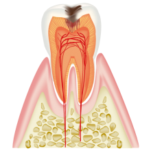 象牙質まで進行した虫歯（C2）