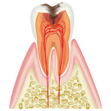神経まで進行した虫歯（C3）