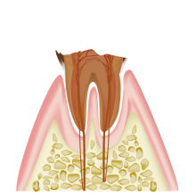 歯の根っこまで進行した虫歯（C4）